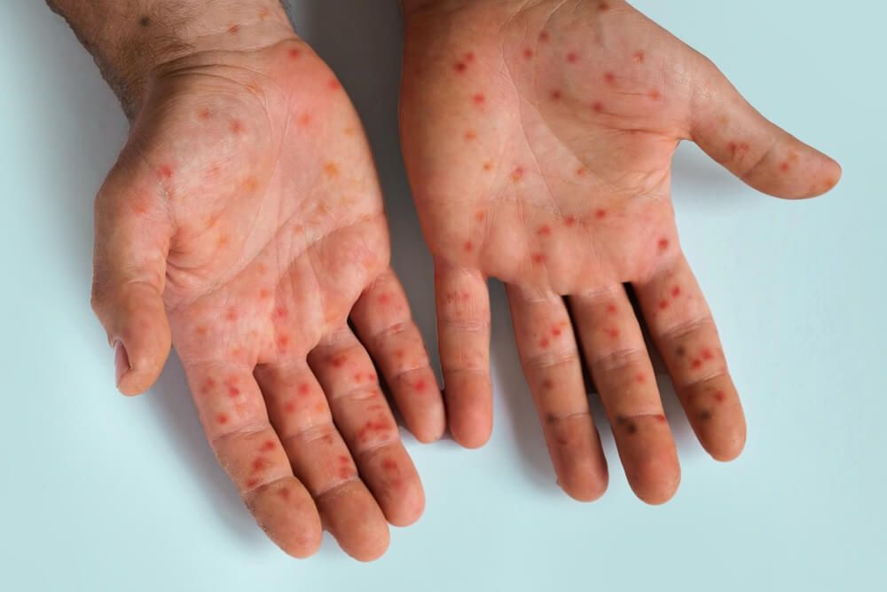 25-measles-brain-complications.jpg
